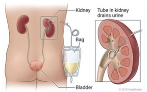Percutaneous Nephrostomy Tube.jpg