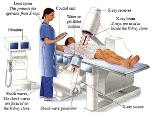lithotripsy.jpg